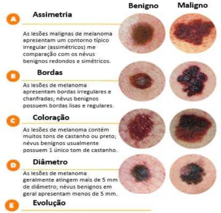 Fig 1  –  Critério de diagnóstico das lesões de melanoma (ABCDE do Melanoma).  Critério  clínico que considera a assimetria das lesões, a irregularidade das bordas, a alteração de  coloração, o diâmetro superior à 5 milímetros e por fim, a evolução fenotíp