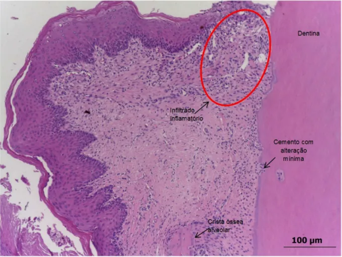 Figura 10 - Grupo Arnica 6CH, 14dias, face mesial do 1º molar inferior esquerdo (aumento 10X) com  infiltrado inflamatório de moderado a intenso