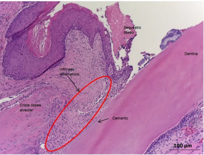 Figura  11  -  Grupo  H 2 O,  14  dias,  face  mesial  do  1º  molar  inferior  esquerdo  (aumento  10X)  com  infiltrado inflamatório intenso e sequestro ósseo