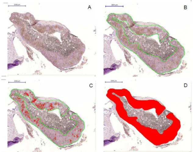 Figura  2.  Fotomiografia  de  linfonodo  broncopulmonar  de  asma  (A);  área  cortical  selecionada  (B);  área  cortical  selecionada  com  marcação  de  área  positiva de CD20+ (C); área cortical para exemplificar marcação de área total  (D)