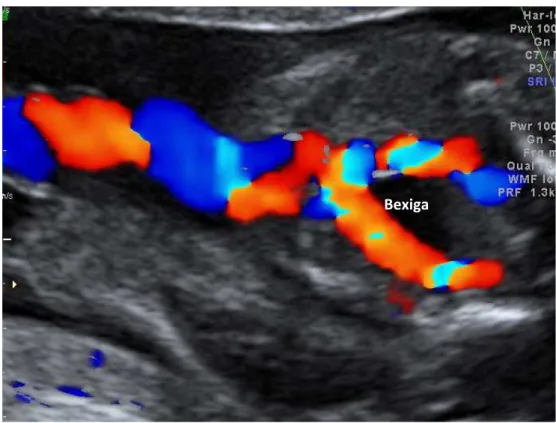 Figura 7 -   Corte transversal da pelve fetal, no segundo trimestre da  gestação, no nível da bexiga urinária