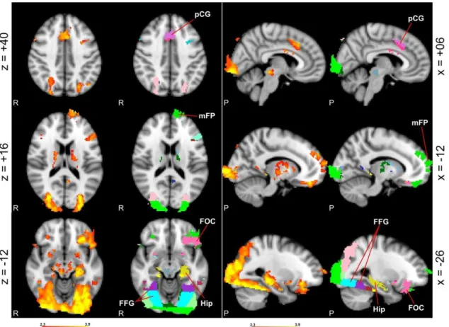 Figure 16 - Activations obtained with the conjunction analysis (statistical parametric  maps produced by FEAT)