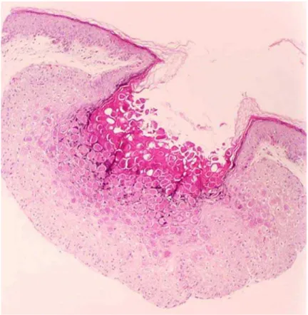 Figura 2 - Molusco contagioso: presença de invaginação da epiderme hiperplásica  com formação de estrutura crateriforme