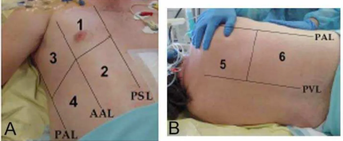 Figura 1 -   As regiões de interesse avaliadas pelo ultrassom pulmonar.  Em  cada paciente, seis regiões de interesse foram examinadas em cada hemitórax, delineadas  pelas linha paraesternal (PSL), linha axilar anterior (AAL), linha axilar posterior (PAL) 