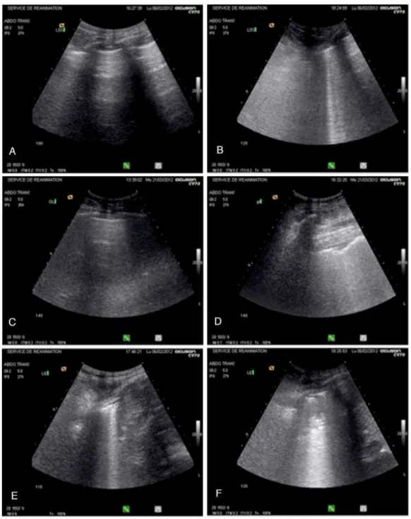 Figura 2 -   Imagens representativas ilustrando as mudanças ultrassonográficas  pulmonares observadas após a infusão de fluidos em três pacientes com  choque séptico e síndrome do desconforto respiratório agudo