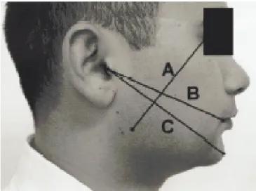 Figura 2- Método utilizado por Üstün et al. (2003) para medida do edema facial.    