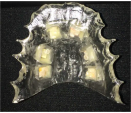 Figura 4.8 - Dispositivo intraoral palatino com espécimes de RC, CIVMR e CIVAV em substrato hígido         e cariado, antes da colocação da tela plástica 