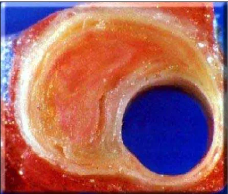 Figura 3: Corte de artéria coronária humana corada em vermelho. As estrias de  gordura no pericárdio aparecem em vermelho vivo e a placa, rica em lipídeos, 