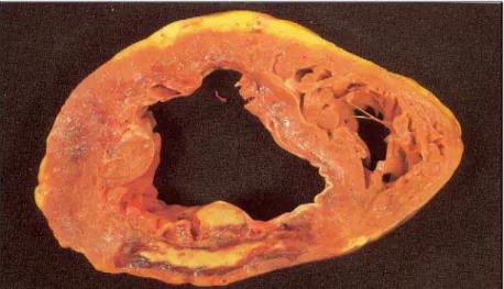 Figura 4: Corte seccional em necropsia de coração mostrando infarto posterior  recente