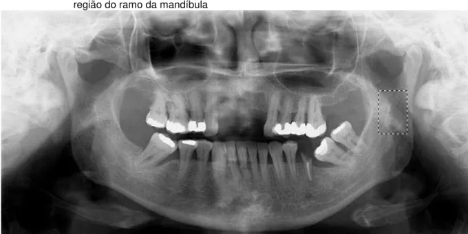 Figura 4.3 -  ROI estabelecido em 200px X 300px de ambos os lados (direito/esquerdo) focando a  região do ramo da mandíbula 