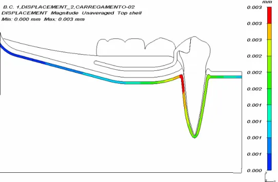 Figura 6.14-  Panorama de deformação (mm) do osso cortical para carregamento 2 do  modelo A 