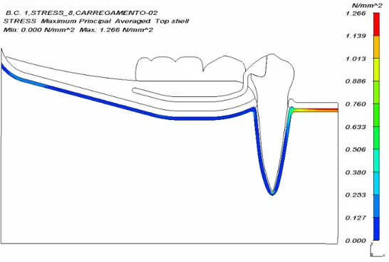 Figura 6.18- Panorama de tensão máxima principal (N/mm 2 ) do osso cortical para  carregamento 2 do modelo A   