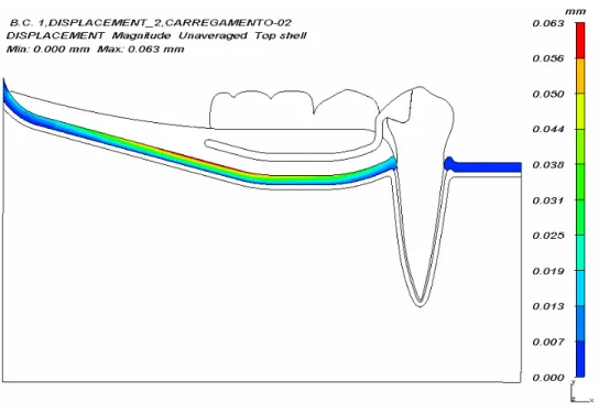 Figura 6.2- Panorama de deformação (mm) da fibromucosa para carregamento 2 do modelo  A 