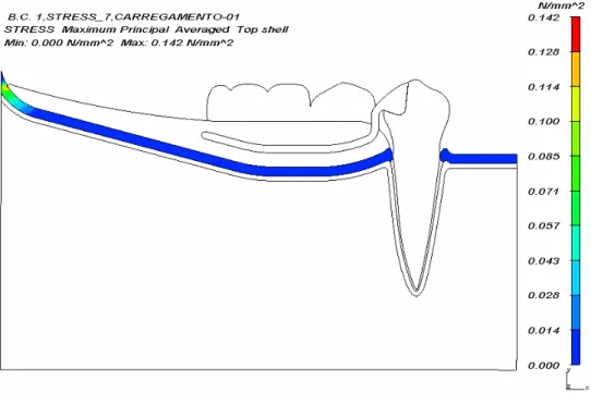 Figura 6.5- Panorama de tensão máxima princ ipal (N/mm 2 ) da fibromucosa para    carregamento 1 do modelo A