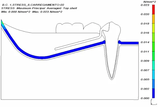 Figura 6.8-  Panorama de tensão máxima principal (N/mm 2 ) da fibromucosa para  carregamento 2 do modelo B  