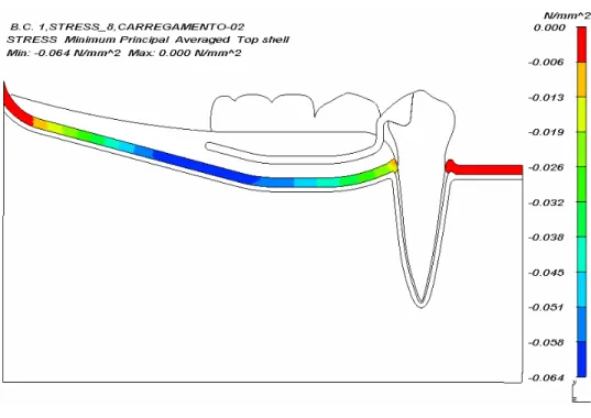 Figura 6.10- Panorama de tensão mínima principal (N/mm 2 ) da fibromucosa para  carregamento 2 do modelo A  