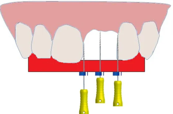 Figura  3:  Imagem  esquemática  representando  uma  placa  acrílica  individualizada  e  adaptada  aos  dentes  do  paciente  adjacentes  à  área  da  exodontia