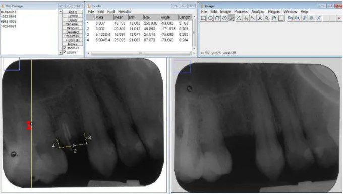 Figura 5: Imagem comparativa das tomadas radiográficas do pré-operatório (esquerda), e após seis  meses  da  exodontia  (direita)