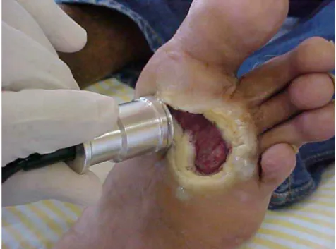 Figura 20 - Foto ilustrativa da aplicação do transdutor ultra-sônico em  uma das úlceras de grande extensão