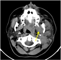 Figura 4.5 - Imagem de TC,corte axial com janela para tecido mole, mostrando edema do  músculo pterigoideo medial 