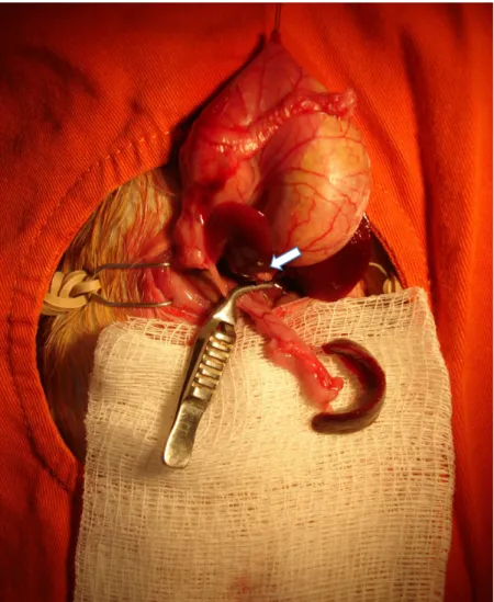 Figura 4. Isquemia da cauda do pâncreas com pinça microvascular atraumática (seta). 
