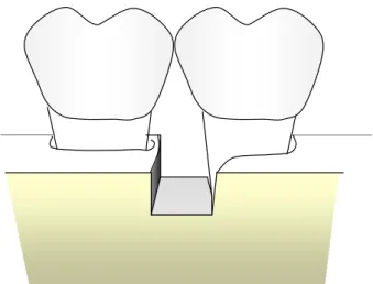 Figura 4.1 - Defeito de 1 parede no septo interdentário: remoção das corticais ósseas, permanecendo                    apenas a parede proximal