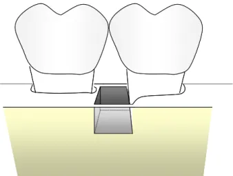 Figura 4.3 - Defeito de 3 paredes no septo interdentário: remoção do trabeculado ósseo, restando as  corticais vestibular, lingual e proximal 