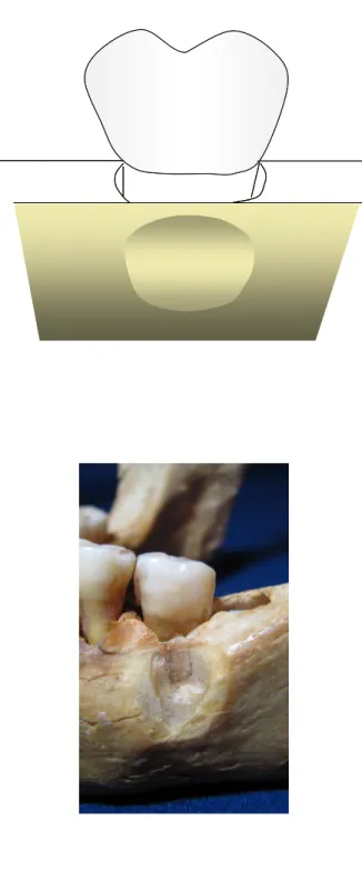 Figura 4.6 - Depressão óssea: grande desgaste ósseo na cortical vestibular sobreposta à porção  radicular do dente, sem a exposição radicular 