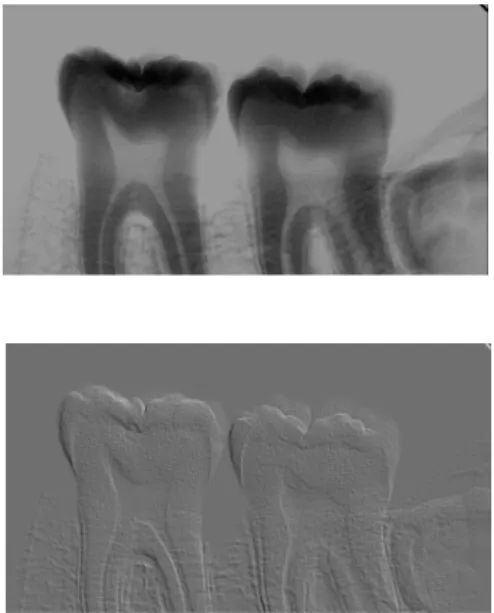 Figura 5.2 - Imagens de RD e TCFC demonstrando defeito ósseo de 2 paredes entre o 1º e o 2º  molar inferior esquerdo 