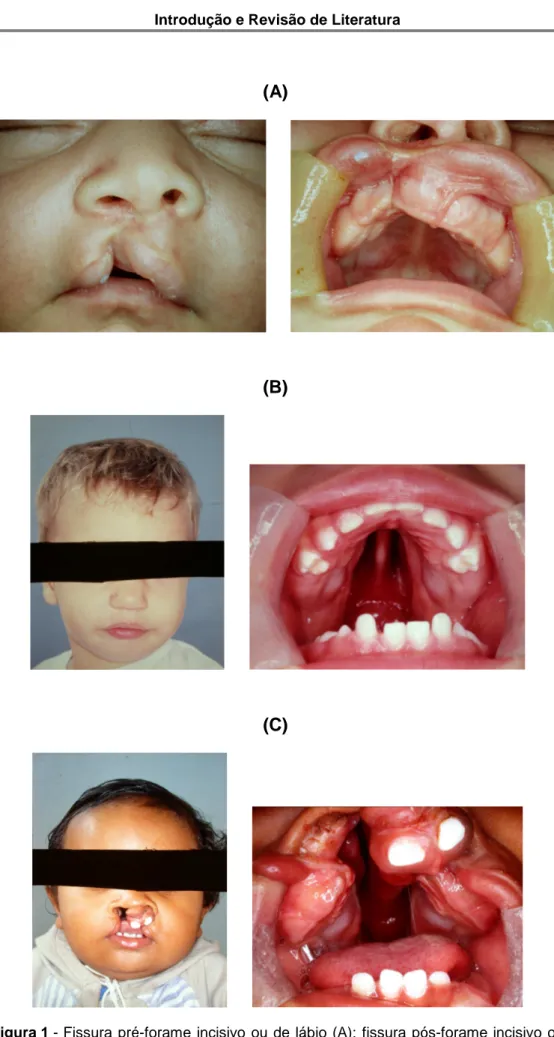 Figura 1 - Fissura  pré-forame  incisivo  ou  de  lábio  (A);  fissura  pós-forame  incisivo  ou  de palato (B); fissura transforame incisivo ou de lábio e palato (C)