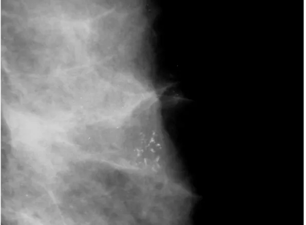 Figura 5. Mamografia de paciente, com 53 anos, apresentando calcificações  de morfologia pleomorfa e distribuição agrupada – AP: CDIS 