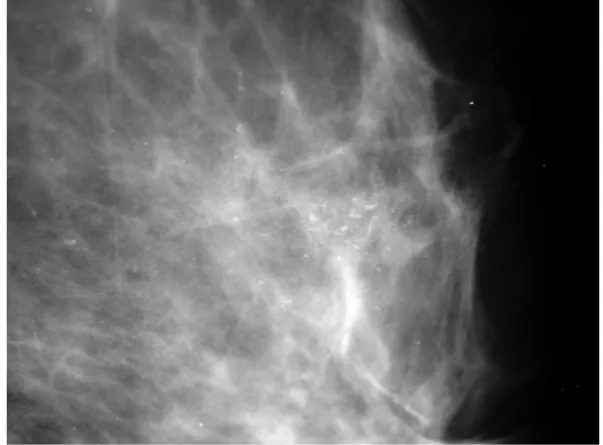 Figura 7. Mamografia de paciente, com 72 anos, apresentando calcificações  de morfologia linear e distribuição segmentar – AP: CDI 