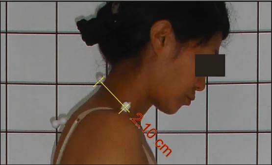Figura 12 - Avaliação quantitativa da postura do ombro no plano sagital 