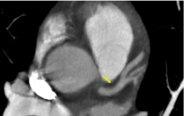 Figura 6 - Exame de paciente com 12 anos de evolução pós-transplante, por miocardiopatia  isquêmica,  mostrando  artéria  descendente  anterior  com  placa  não  calcificada  no  terço  proximal