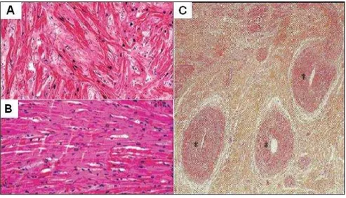 Figura  1  -  Cortes  histológicos  corados  com  hematoxilina  e  eosina.  (A)  Observa-se  desarranjo  miofibrilar, com miócitos hipertrofiados e bandas musculares em diferentes direções, desorganizadas,  separadas  por  tecido  conectivo  e  colágeno  s