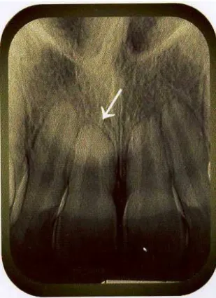 FIGURA 4.7 - Radiografia periapical de incisivo com grau 2 de reabsorção