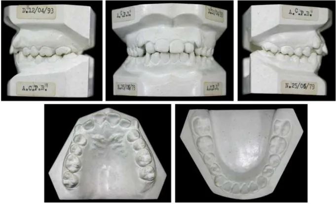 Figura  1.  Modelos  de  estudo  iniciais  de  paciente  pertencente  ao  Grupo  1  (Classe  II,  divisão  1,  completa, bilateral, com trespasse horizontal menor que 3 mm).