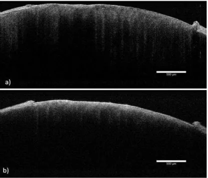 FIGURA 19- Imagens de OCT para as amostras sadia (a) e desmineralizada após 15 dias  de ciclagem (b)