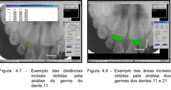 Figura  4.7  -  Exemplo  das  distâncias  incisais  obtidas  pela  análise  do  germe  do  dente 11