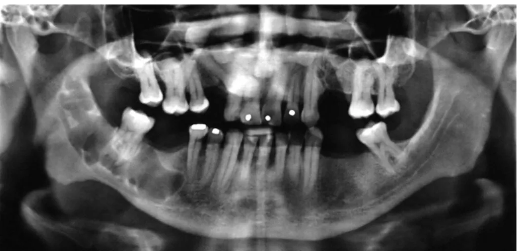 Figura 2 -  Imagem  radiográfica  panorâmica  mostrando  um  tumor  odontogênico  queratocístico  na  mandíbula  direita