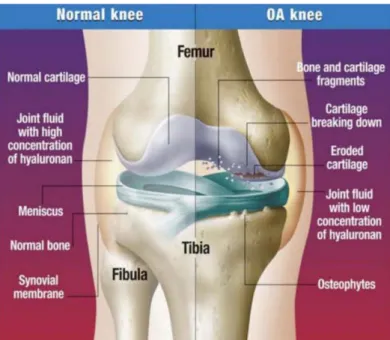 Figure  2.1 - Healthy joint and joint with OA (femoral-tibial compartments). 
