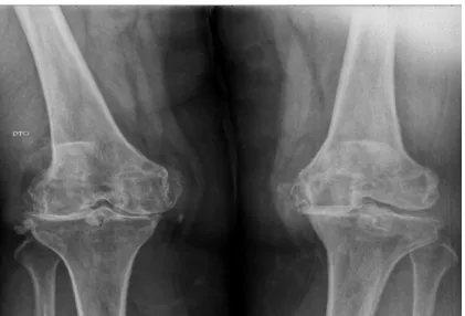 Figure 2.2 - Anteroposterior radiograph of  knee joint  with osteoarthritis. Note the  greatly  narrowing of  joint space in lateral compartment (right knee and medial compartment (left knee) and marginal osteophyte  formation
