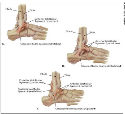 Figura 3 –  A. Distensão dos ligamentos calcaneofibular e talofibular anterior. B. Rotura parcial  dos ligamentos calcaneofibular e talofibular anterior