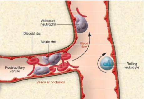 Figura  2.  Oclusão  Vascular  na  A.F.  A  oclusão  vascular  na  AF  é  mediada  por  múltiplos  elementos  celulares,  incluindo  eritrócitos  falcizados,  células  endoteliais,  leucócitos  aderentes  e  plaquetas,  cada  etapa  pode  representar  um  