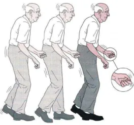 Figura 2 - Representação da imagem motora característica do doente com Doença de Parkinson  (imagem disponível em www.google.com) 