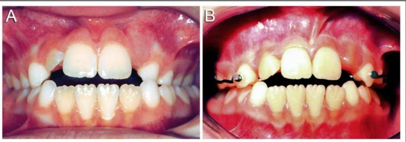 Figura 3 – Vista frontal antes da correção da mordida cruzada posterior (A) e vista frontal após a  correção (B)