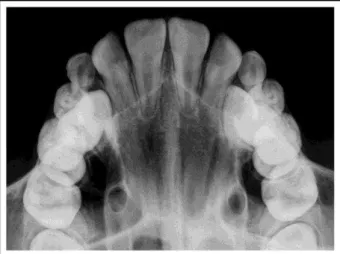 Figura 6 – Radiografia oclusal 6 meses após a obtenção da expansão rápida da maxila. 