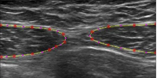 Fig.  II-3.  Rectus abdominis  ultrasound image. Points digitalized by the examiner on the muscles contour (red  dots)