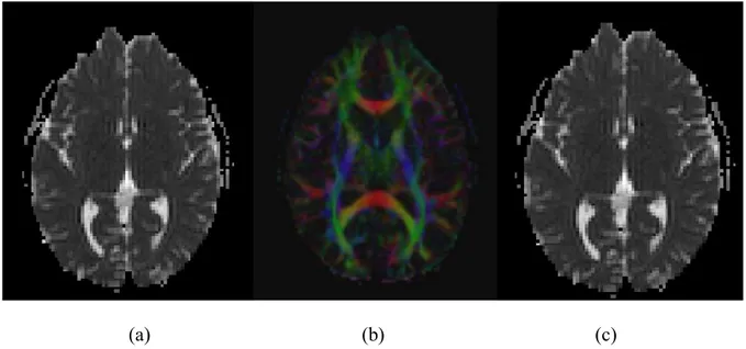 Figura 07: Exemplos de neuroimagens DTI, de um controle saudável, feminino de 32 anos: a)  Difusibilidade média, b) Anisotropia colorida, c) Difusão paralela (há similaridade com a 