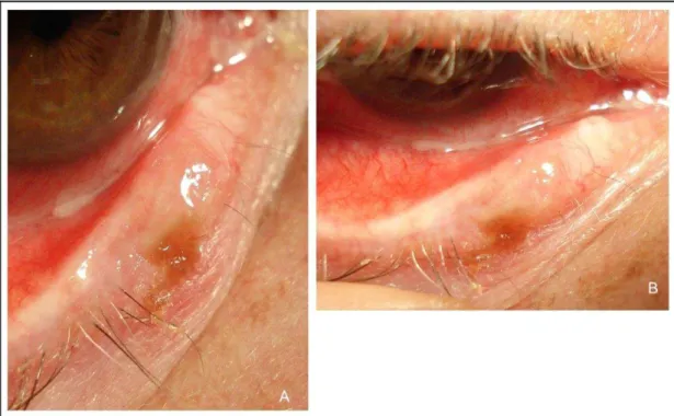 Figura 14. Carcinoma espinocelular: (A) e (B) Lesão plana com margens irregulares 